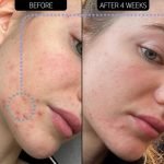 The Inkey List SuperSolutions 2% Novoretin Blemish Clearing Moisturiser 50ml - Image 3