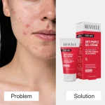Revuele Anti-Pimple Gel Cream 50ml - Image 6